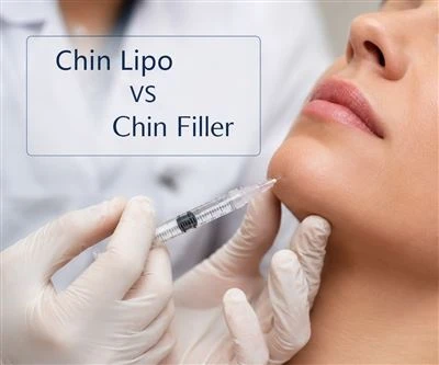 Chin Lipo Vs Pengisi Dagu: Mana Yang Lebih Baik Untuk Kontur Dagu Anda